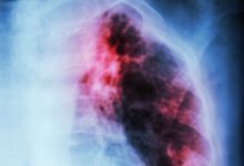 肺结核痰是什么颜色的 如何治疗肺结核?
