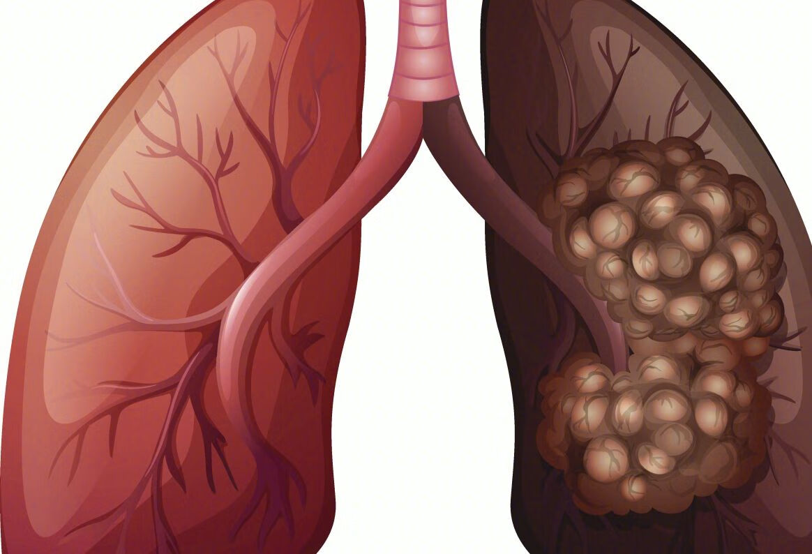 慢阻肺诊断的标准是什么？