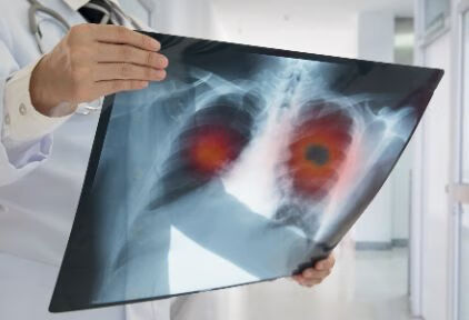 肺癌可以并发哪些疾病？
