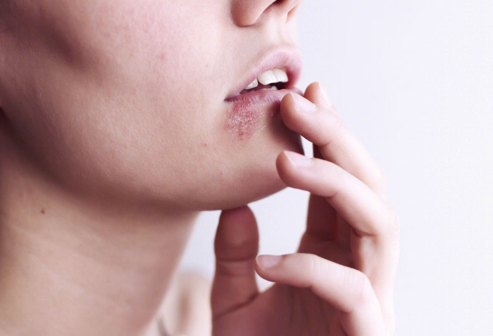 嘴角带状疱疹怎么治疗？