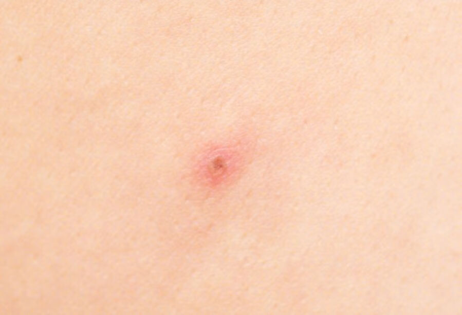 儿童水痘初期症状是什么？