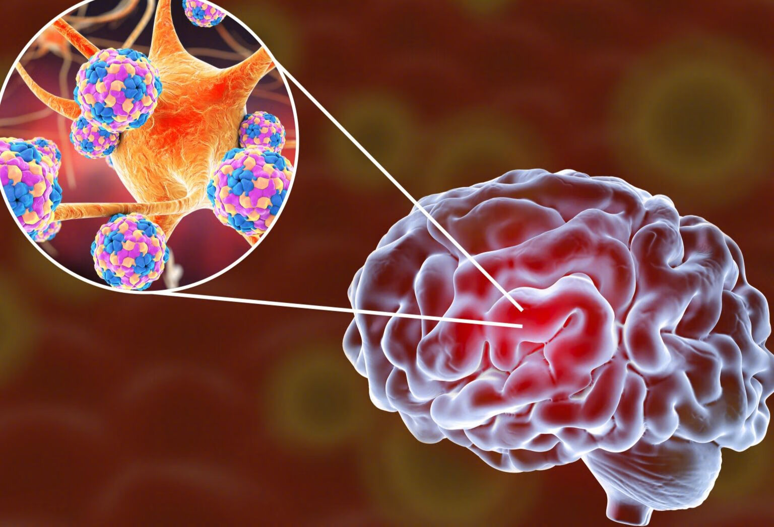 急性脑血管病有哪些？