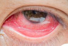 红眼病用药你知道多少？