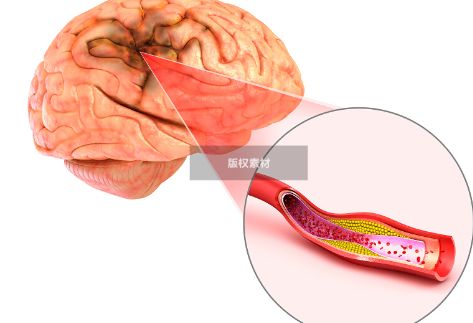 日常养护血管，坚持做好这3件事，脑血管疾病不来扰