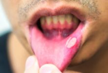 口腔溃疡吃不下饭，介绍几个简便方法