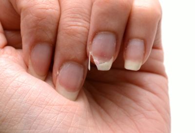 指甲太短易患甲沟炎，剪成这种形状才最“安全”