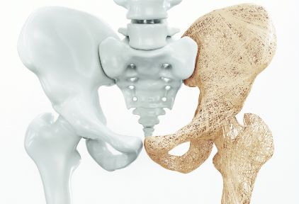 长期服用激素导致骨质疏松该如何治疗？