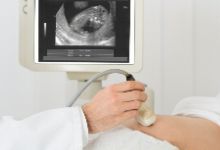 卵巢囊肿是什么原因造成的？