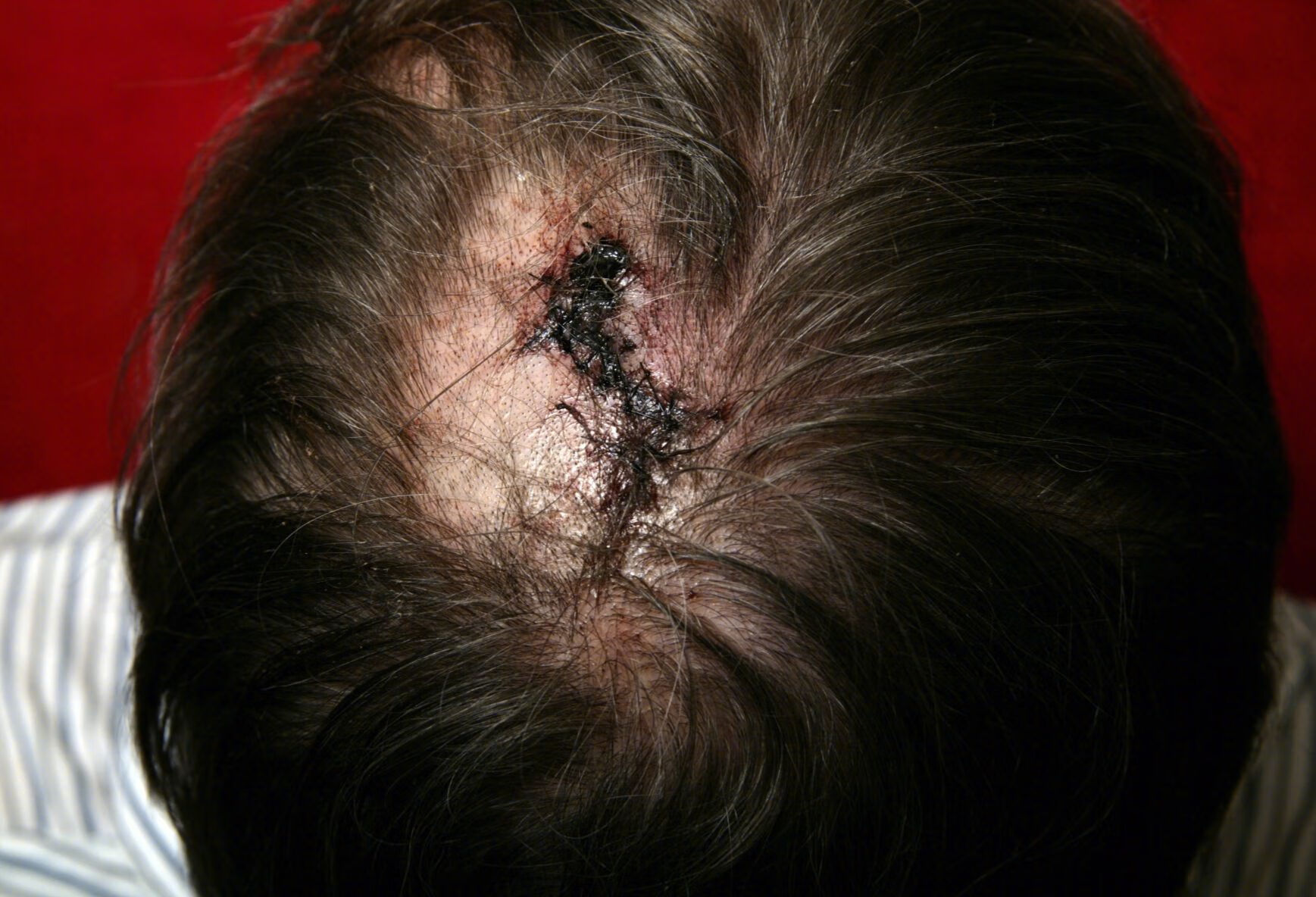 头皮裂伤应做哪些检查？如何治疗？