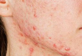 如何预防痤疮让皮肤更健康？
