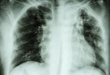 肺结节的治疗方式有哪些？