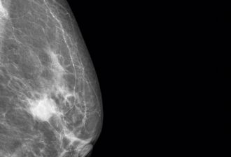 乳腺癌防治要靠“早”，首先乳房保养好
