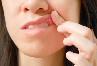 口腔溃疡易复发，清热降火是关键，吃什么食物比较合适？