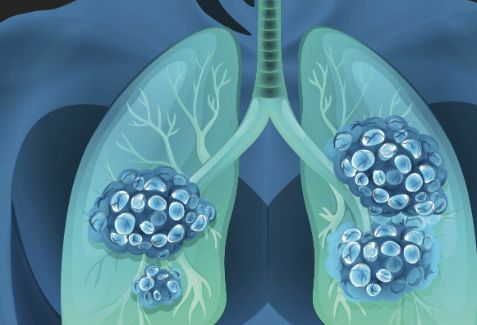  呼吸性细支气管炎间质性肺病病因及检查