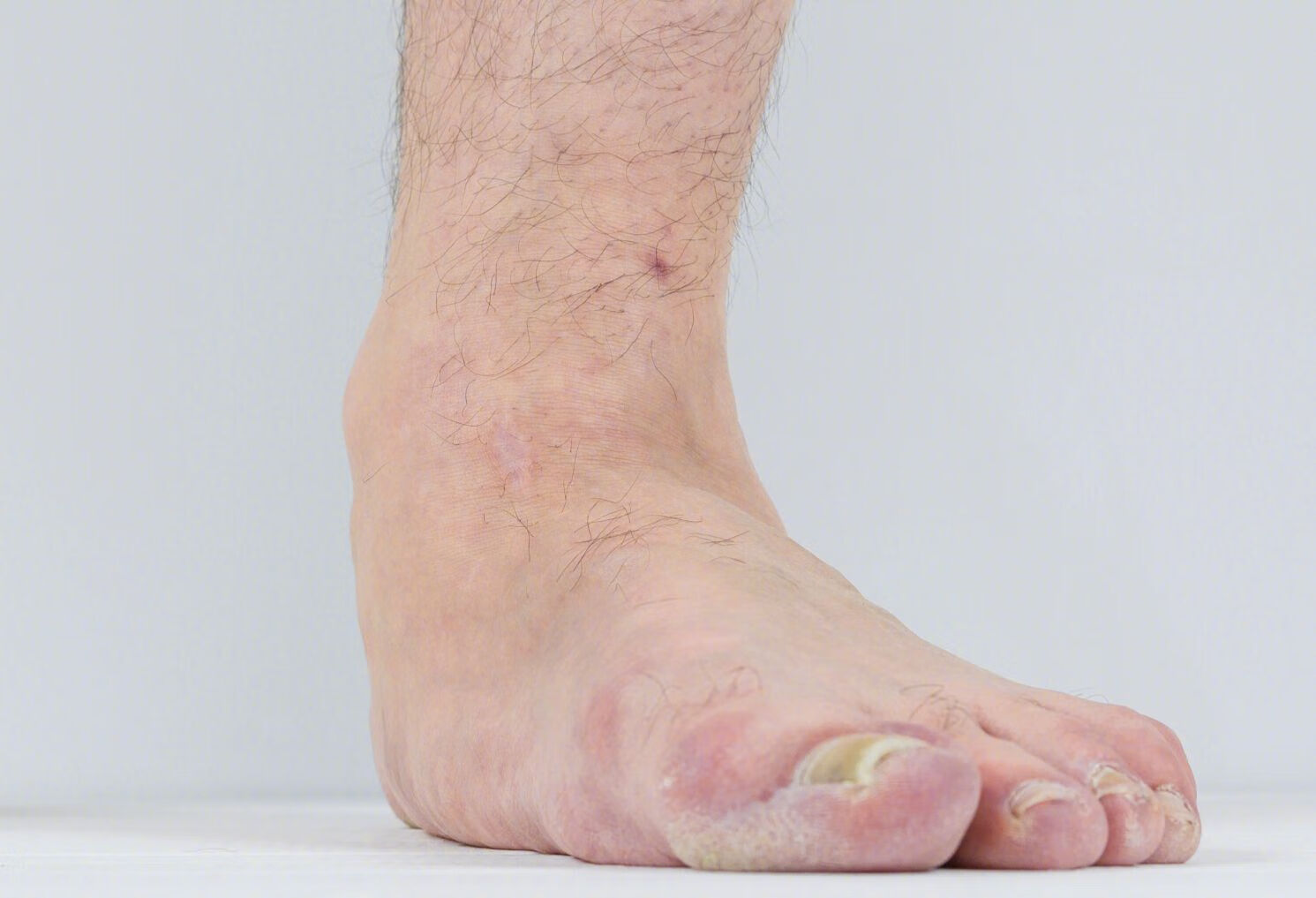 脚踝软组织损伤怎么恢复？