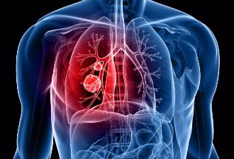 肺癌是“拖”出来的吗？生活中几个表现可能是肺癌，看医生怎么说