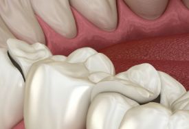 牙龈肿痛是上火导致的吗？4个方法，或能缓解牙龈疼痛