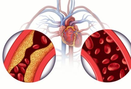 冠状动脉硬化可确定冠心病吗？