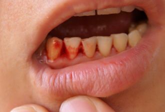 牙龈总是出血？可能是疾病来袭的预兆