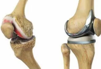 膝关节疼痛、咯吱作响？不可错过的6个拯救膝关节的方法