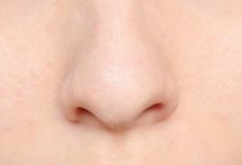 鼻孔大是因为哪些因素影响形成的？如何解决？