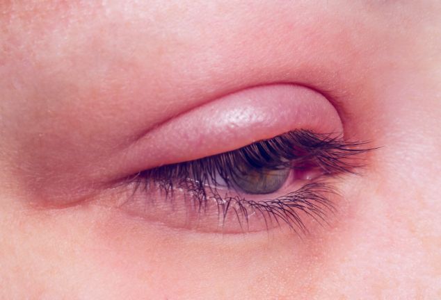 沙眼的治疗和眼睛保护