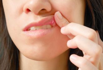 口腔溃疡反反复复总不好，是缺维生素吗？