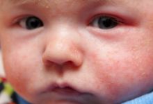 宝宝七个月发烧后起疹子了怎么办？