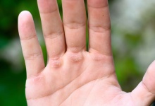 为什么会得手指筋膜炎 分析手指筋膜炎的五个病因