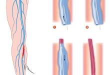 小腿静脉血栓怎么办 详述小腿静脉血栓的四个处理方法