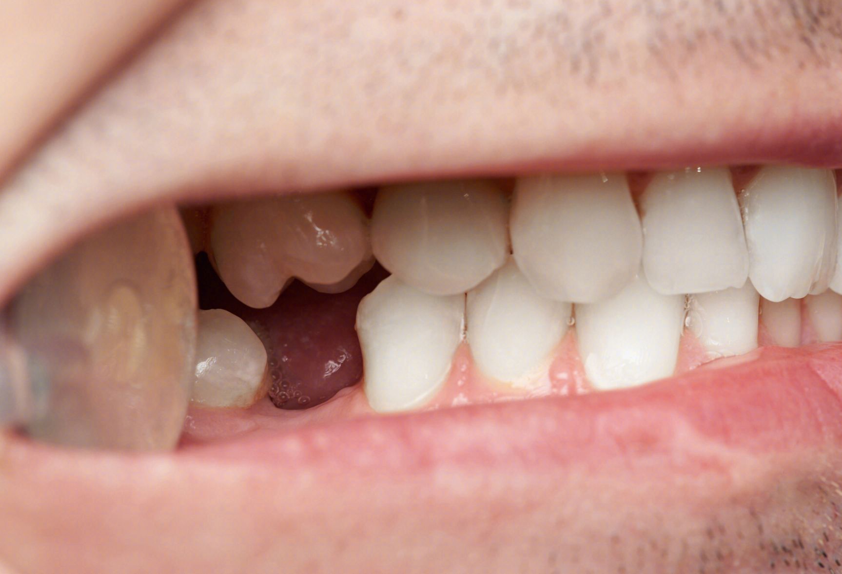 牙齿缺失的危害有哪些？