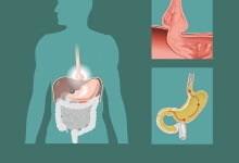 胃酸过多的原因有哪些 胃酸过多的六大诱因剖析