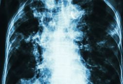 中医如何认识肺纤维化？ 