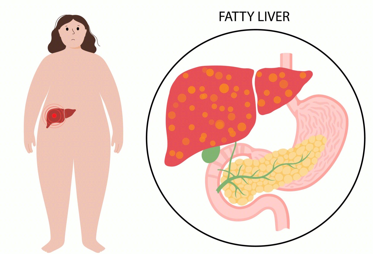 患有脂肪肝要少吃肉？不懂如何饮食的人才容易得脂肪肝