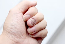 灰指甲的症状和治疗方法