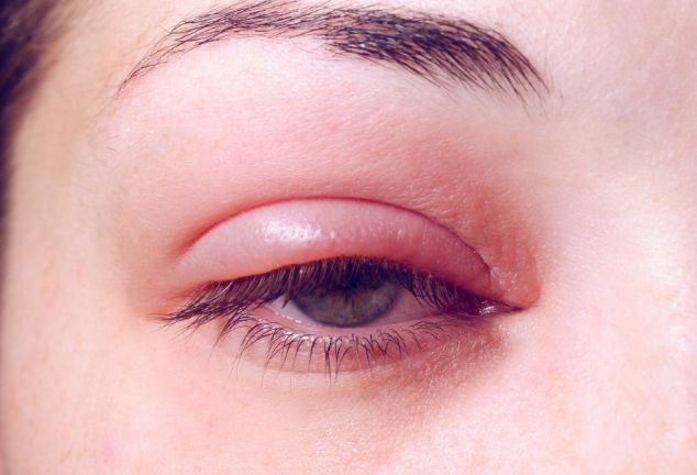 你了解沙眼的治疗和康复吗？