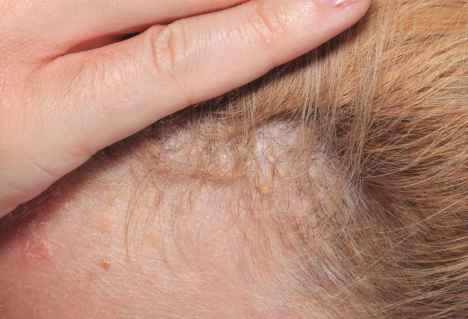 头皮脂溢性皮炎有哪些治疗方式？
