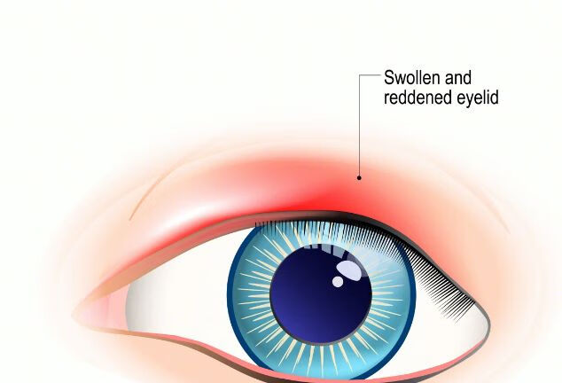 你知道沙眼是如何感染的吗?