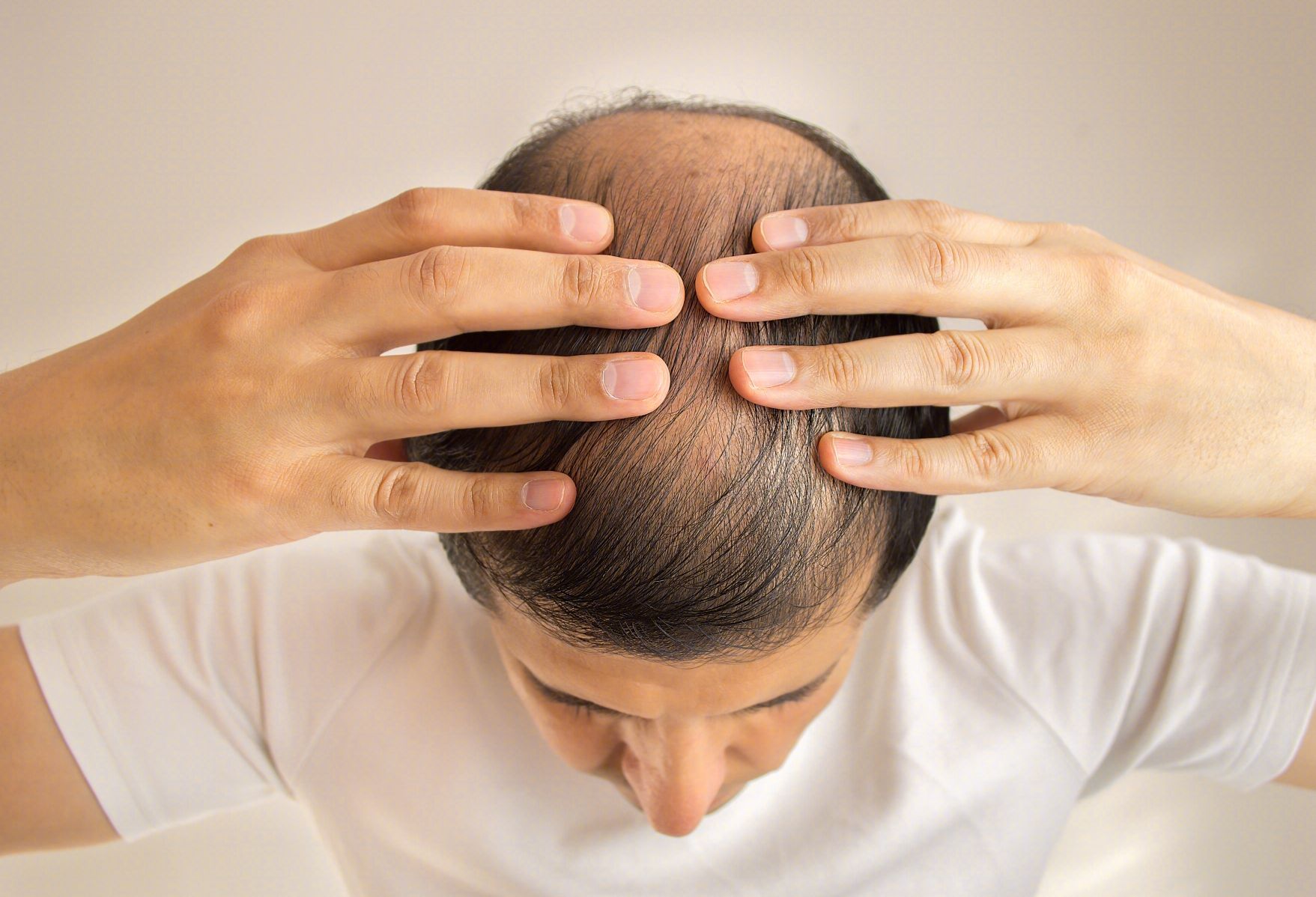 脂溢性脱发的治疗方式都有哪些？