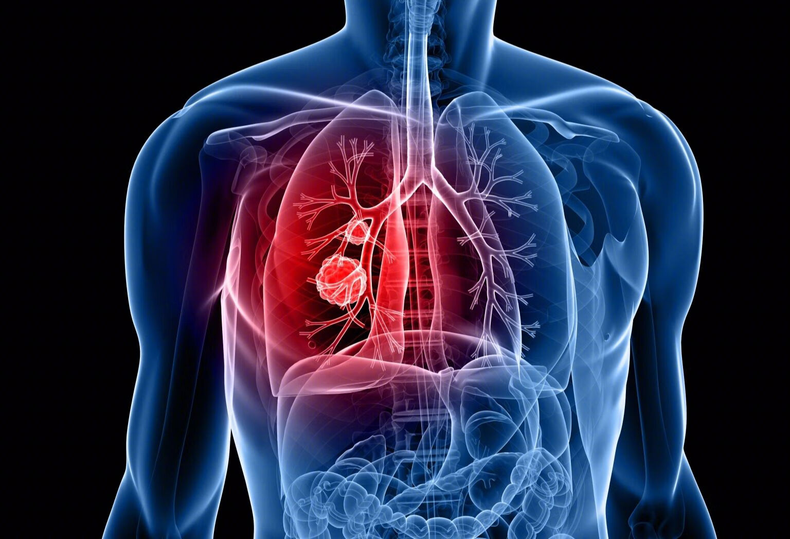 肺癌每年带走60万人！睡觉出现3种信号多是肺癌敲门