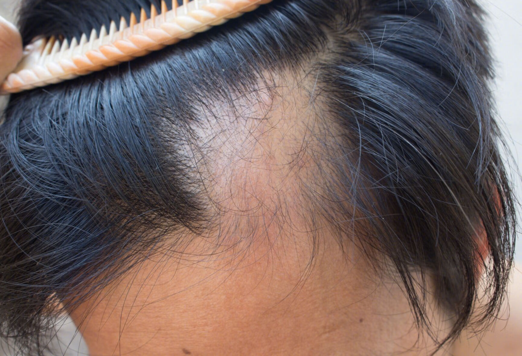 瘢痕性脱发患者有什么需要注意的？