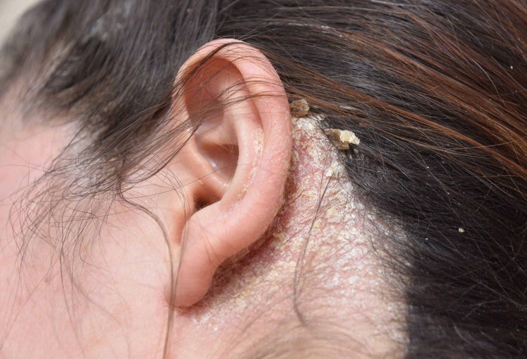 头皮型银屑病会传染么？我们应如何护理？