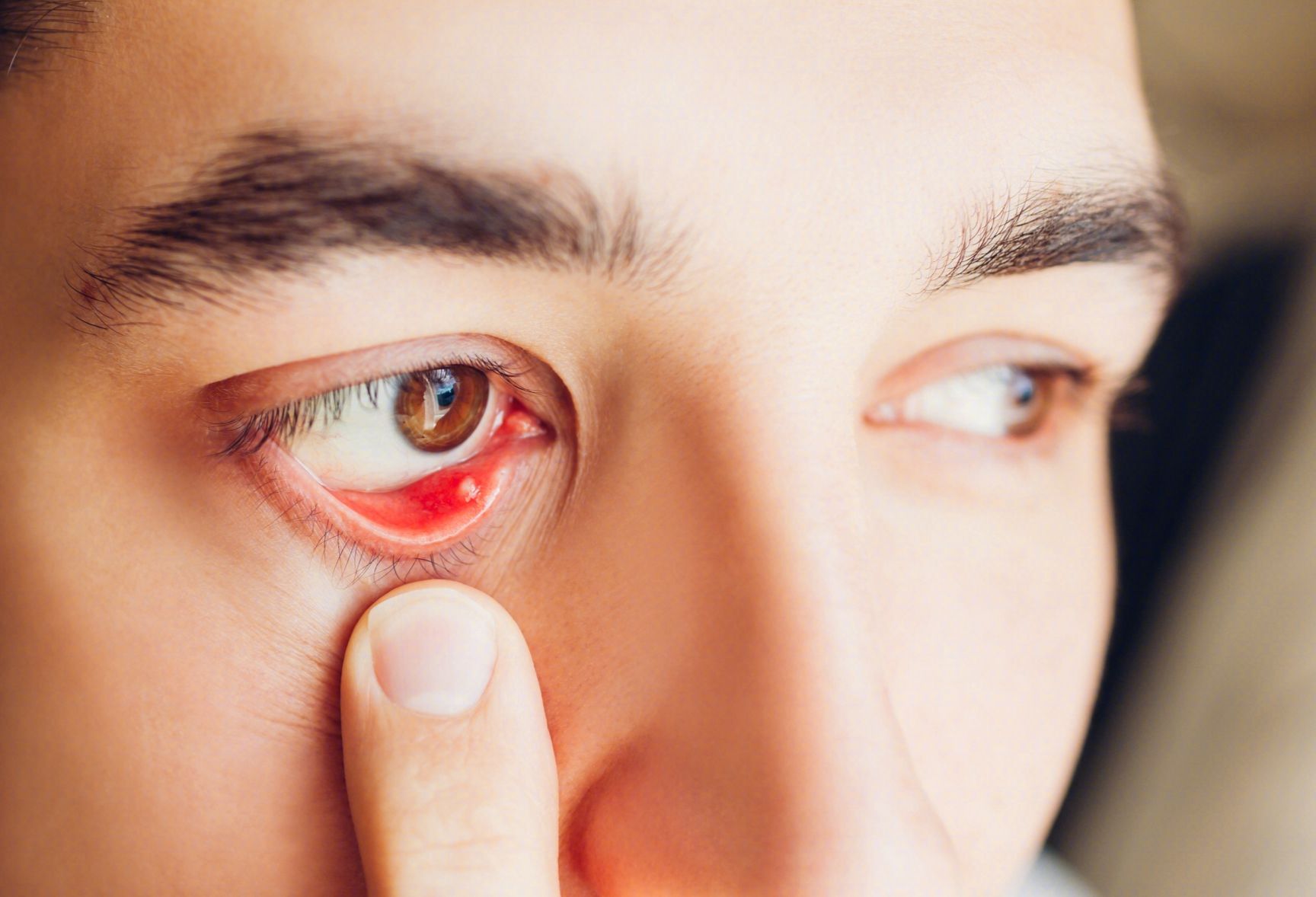 有些心血管病“写”在眼睛上，眼皮下垂、肿胀都是前兆