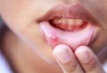 口角炎是缺乏什么维生素引起的 口角炎是怎么回事呢