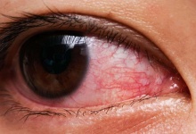 眼睛慢性结膜炎怎么办 用什么眼药水治疗好