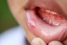 口腔溃疡吃什么水果 揭秘口腔溃疡的水果疗法