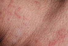 身上痒痒预示你可能有病 六招缓解皮肤瘙痒