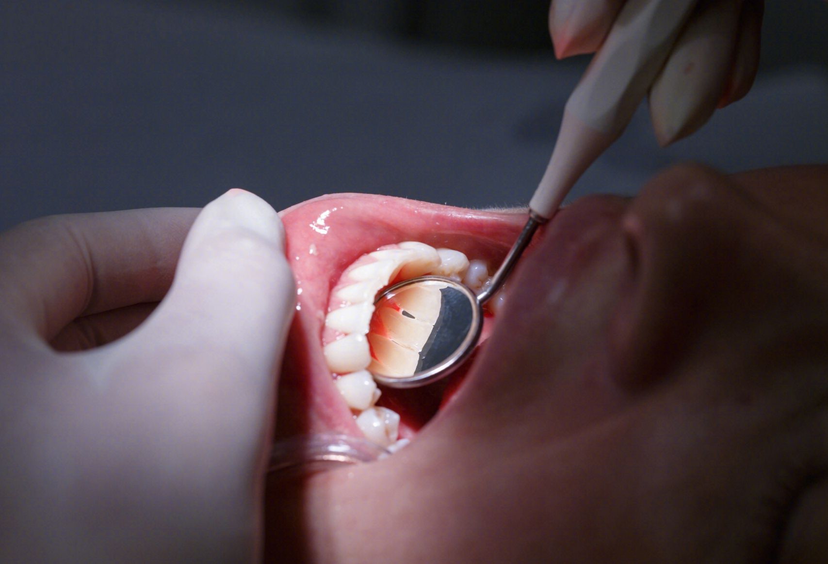 牙结石有哪些治疗方式呢？