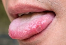 舌头中间有裂纹怎么办