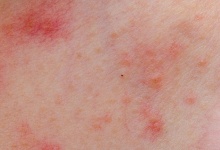 全身皮肤痒起红斑是什么原因 怎么治 3 个治疗方法要知道